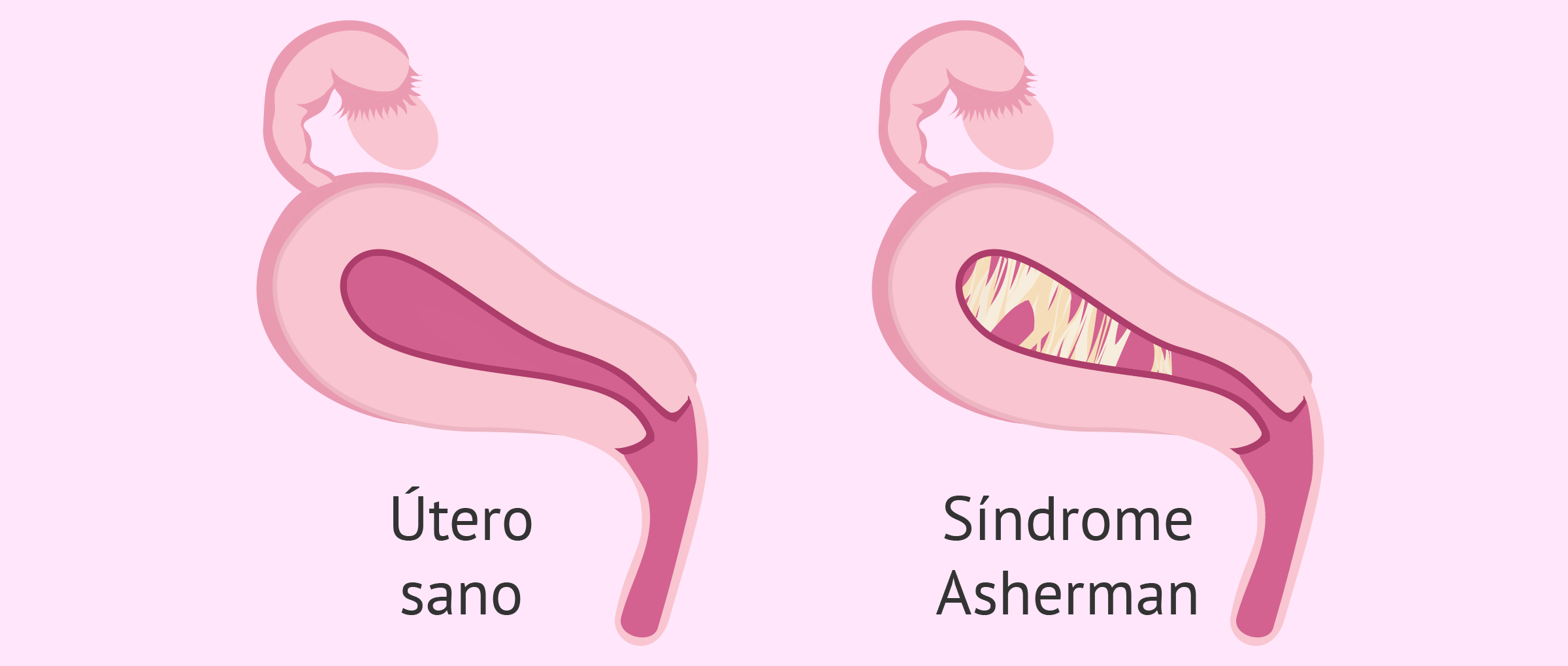 Útero sano vs. útero con adherencias uterinas