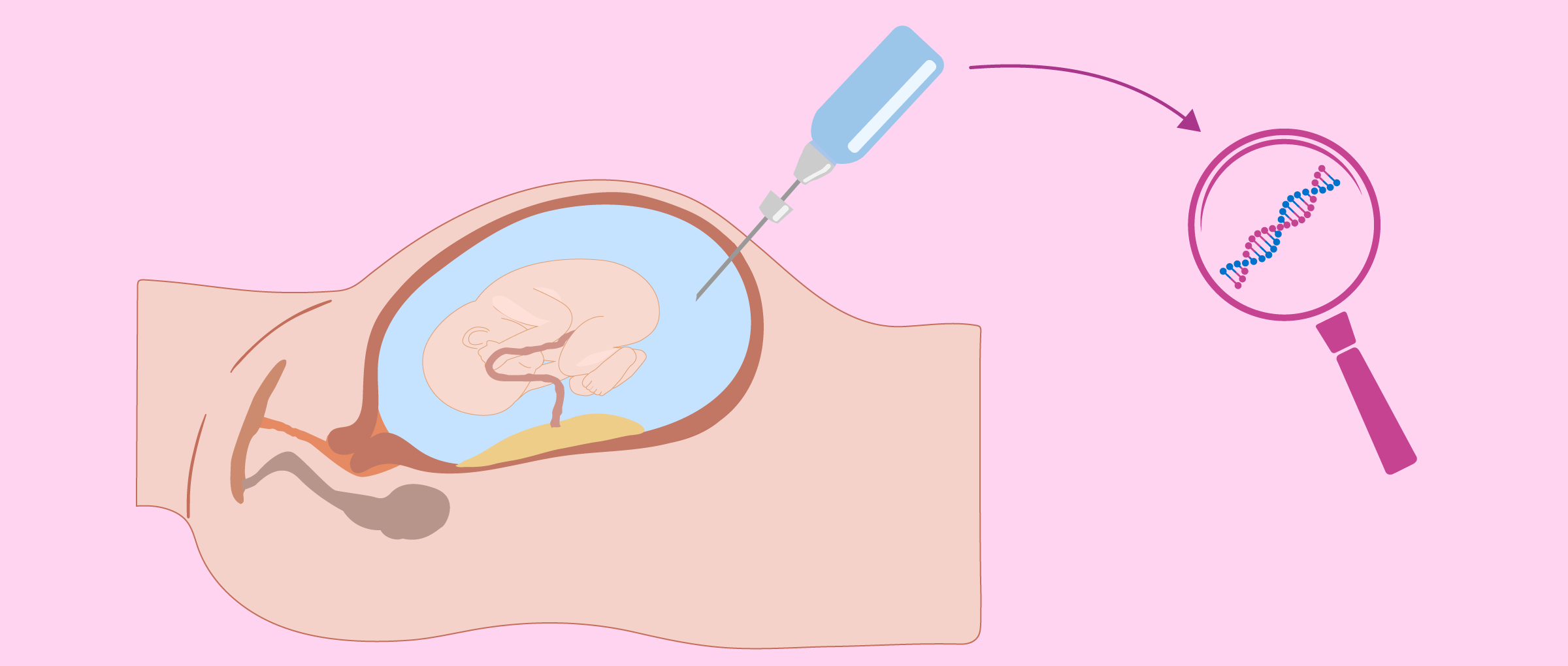 Prueba de amniocentesis en gestación subrogada