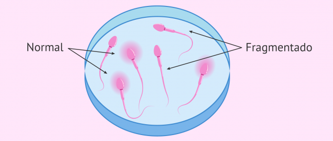 Imagen: Fragmentación del ADN de los espermatozoides