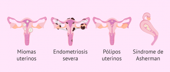 Imagen: Anomalías uterinas graves e incapacidad para gestar