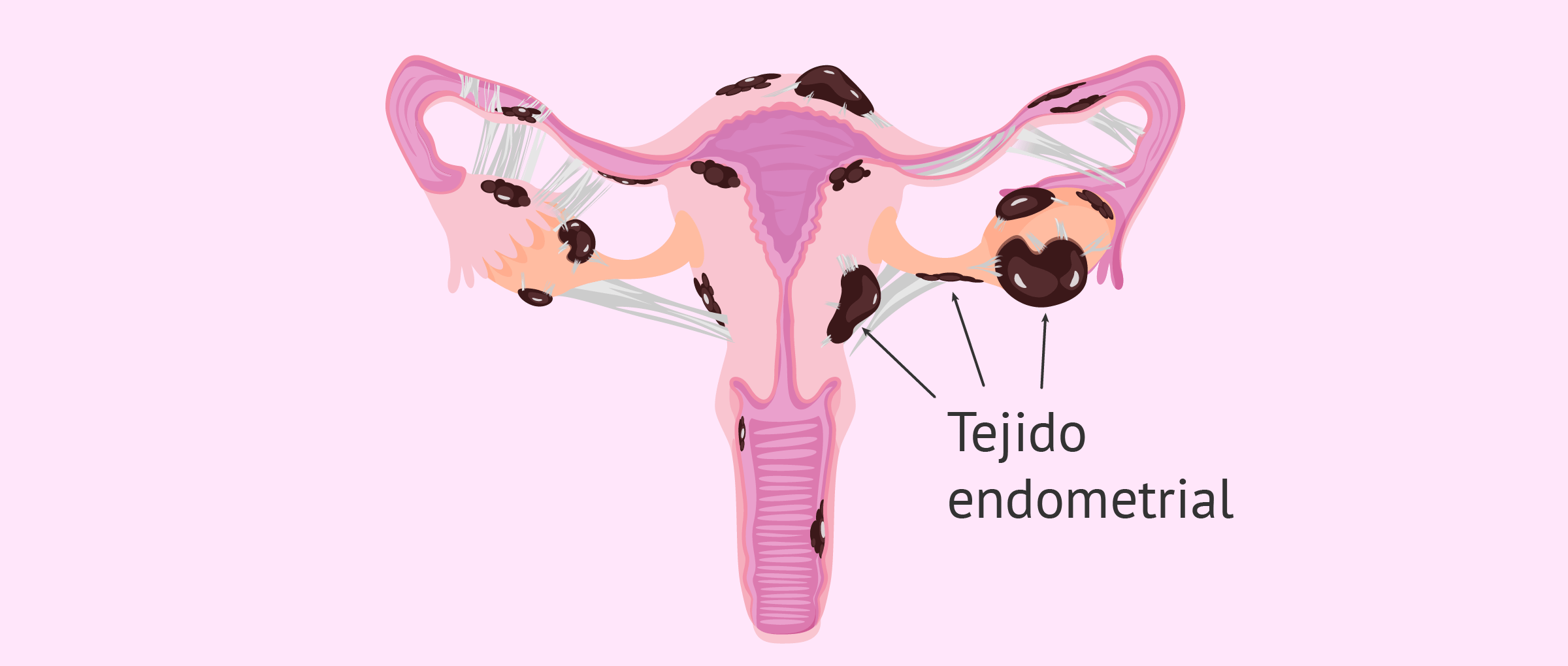 Endometriosis severa con quistes y endometriomas
