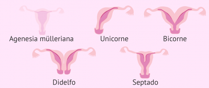 Malformaciones congénitas uterinas