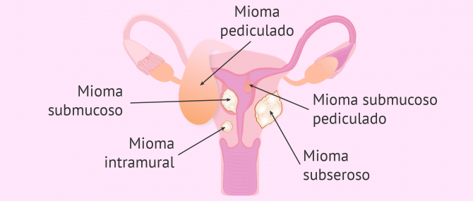 Tipos de miomatosis uterina