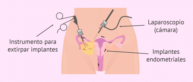 Cirugía para tratar la endometriosis