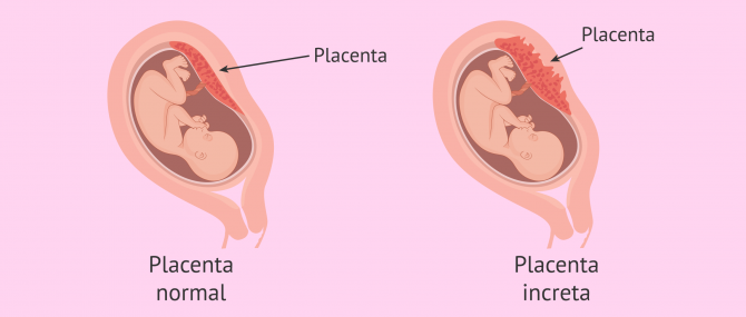 Placenta normal vs. placenta increta