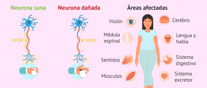 Imagen: Consecuencias de la esclerosis múltiple