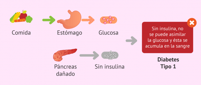 Imagen: Diabetes mellitus tipo 1