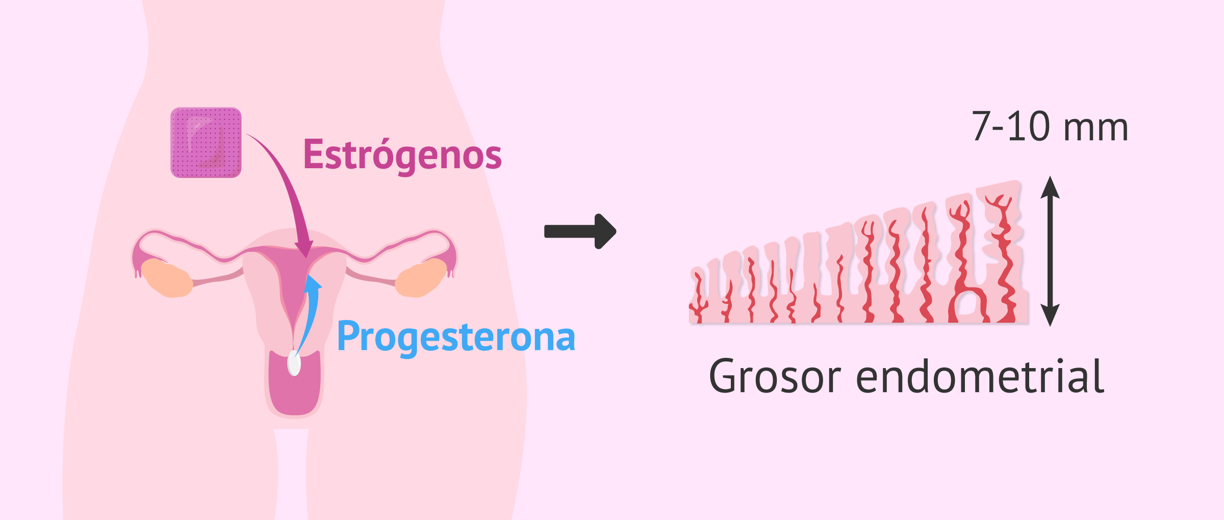 Preparación del endometrio en la FIV