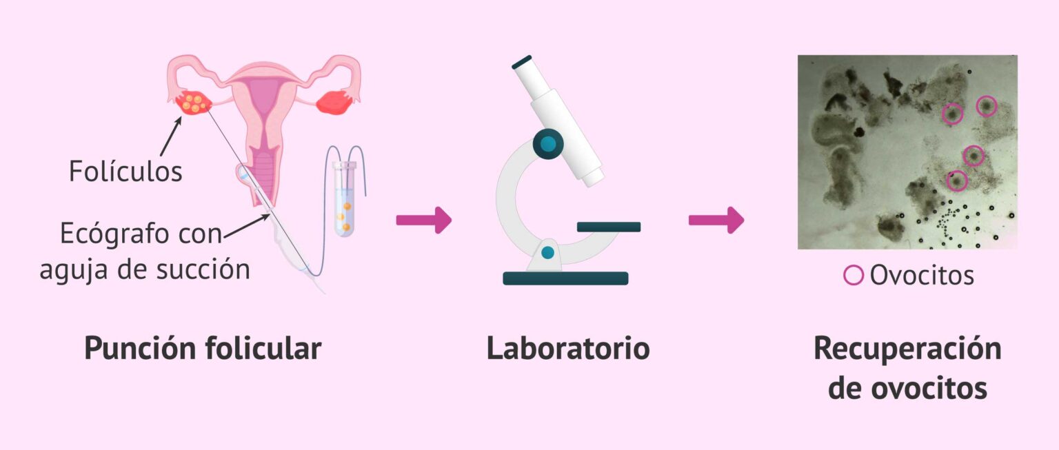 Punción folicular para una FIV-ICSI