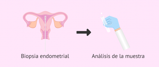 Imagen: Técnica de la biopsia endometrial