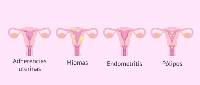 Imagen: TIpos de tumoraciones y alteraciones endometriales