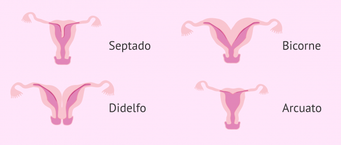 Imagen: Anomalías uterinas comunes