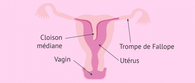 Utérus cloisonné