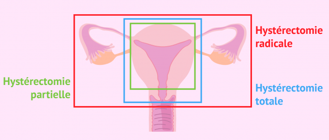 Imagen: Différences entre hystérectomies