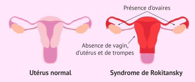 Syndrome MRKH: absence de vagin, d'utérus et de trompes