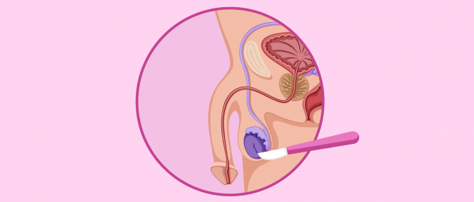 Imagen: La biopsie du testicule