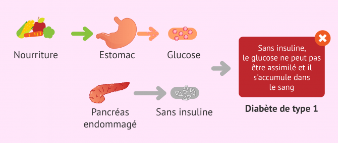 Imagen: Diabète de type 1