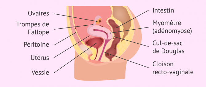 Imagen: localisation endometriose