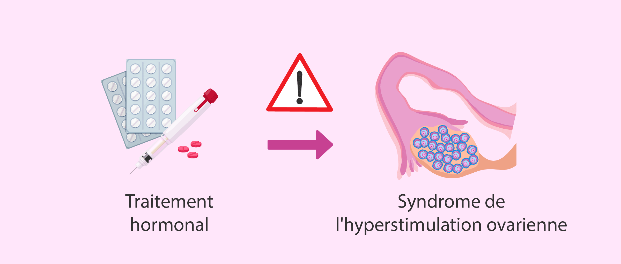 Syndrome d'hyperstimulation ovarienne (SHO)