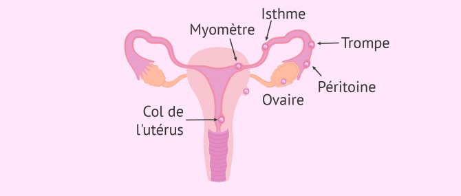 Imagen: types de grossesses extra uterines