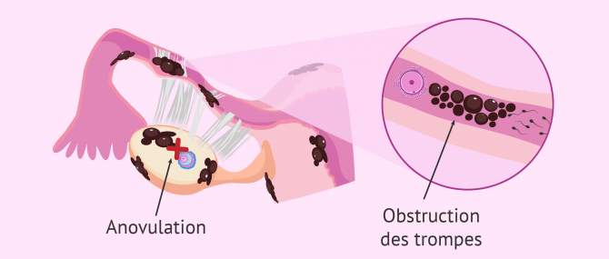 Imagen: endometriose anovulation obstruction des trompes